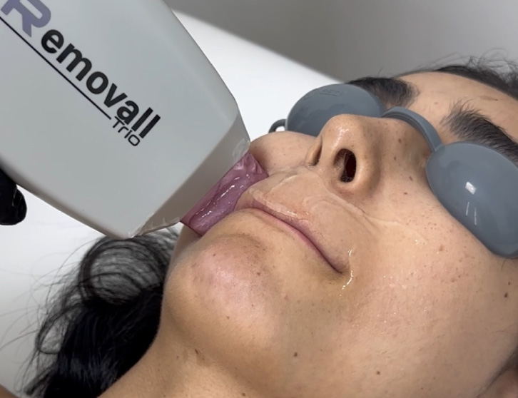 Depilación Láser Removall Trio
