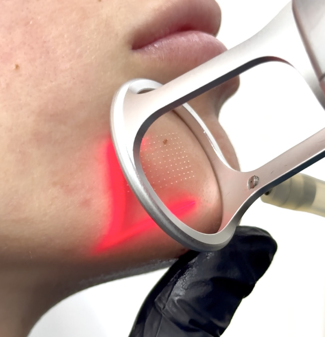 Servicio Tecnología Láser