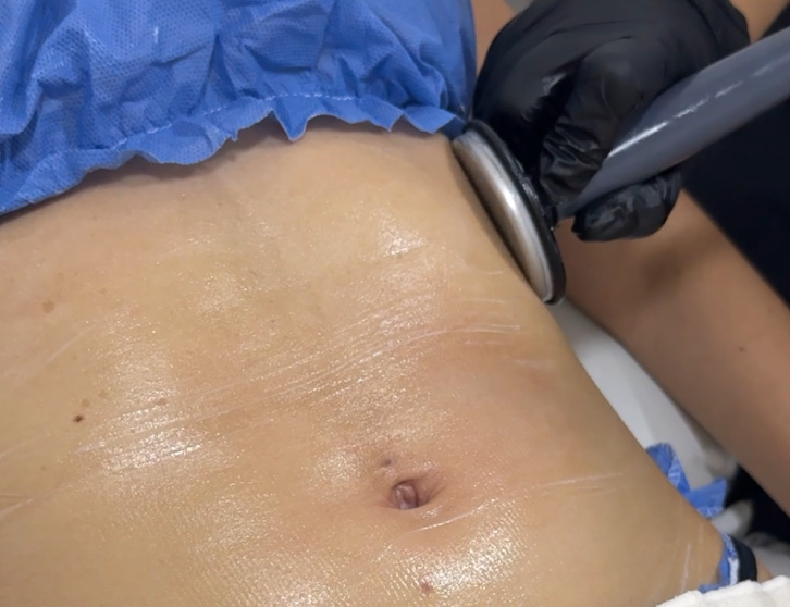 Tensamax Roma Tu Piel